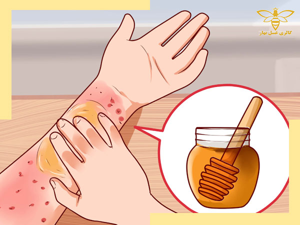 آیا می‌توان از عسل برای درمان زخم استفاده کرد؟