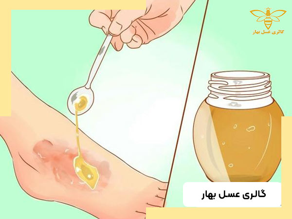 از چه نوع عسلی برای درمان زخم استفاده می‎‎شود؟